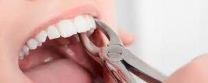 Рекомендации и профилактика после удаления зуба